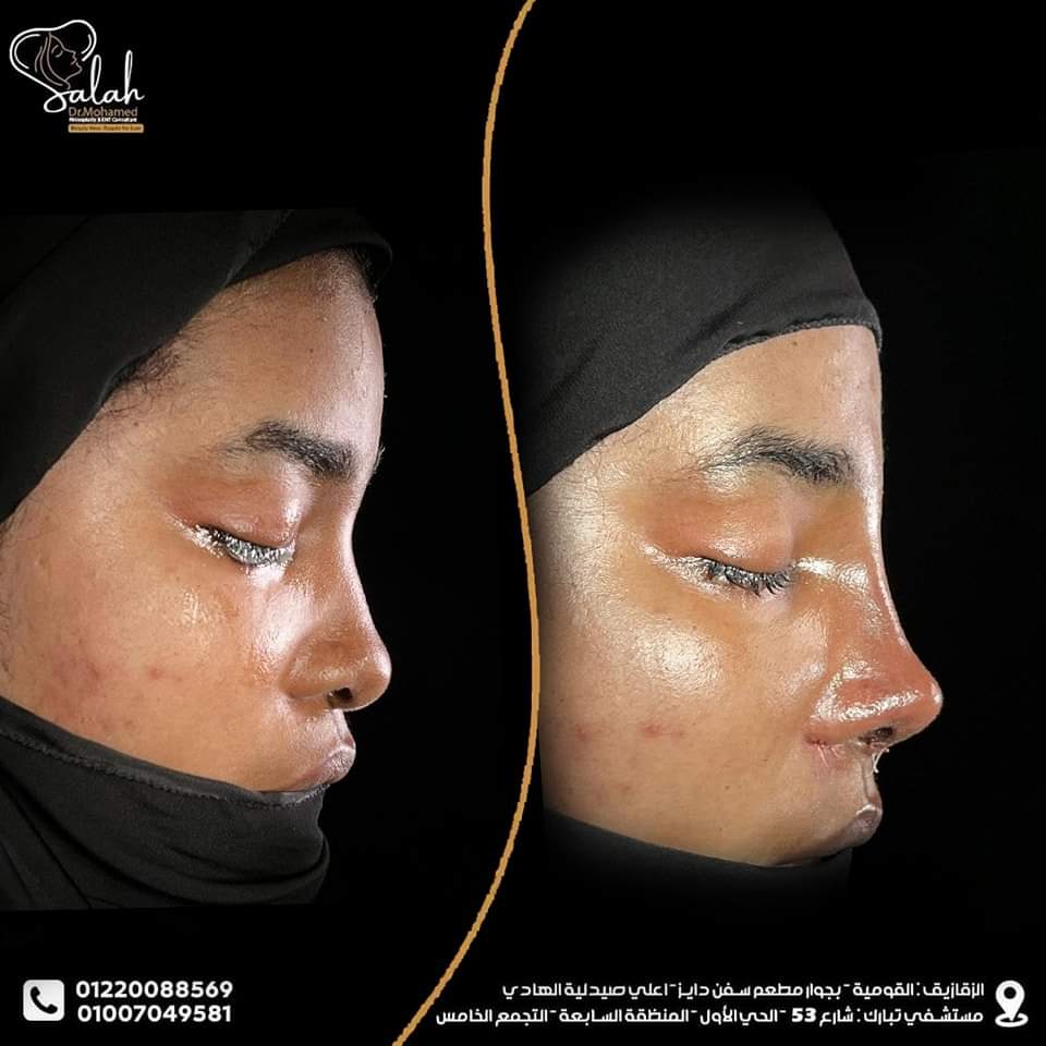 African Nose Rhinoplasty